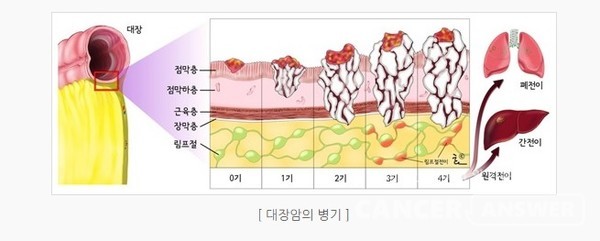 대장암은 다른 암들과 달리 수술을 한 후에 정확한 병기를 설정한다. /국가암정보센터
