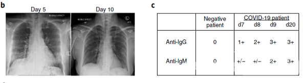 코로나19 바이러스 감염증에서 완치된 특정 환자의 몸에서 독감과 싸울 때 나타나는 면역세포 4가지를 한 호주 연구진이 확인했다. / 네이처 메디슨 캡처