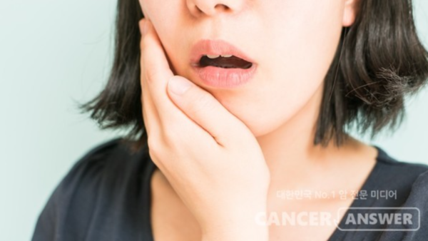 구내염은 일반적으로 7~10일내 사라진다. 특별한 이유 없이 구내염이 2주이상 지속되거나 크기가 커진다면 전문의의 진료를 받아야 한다./게티이미지뱅크