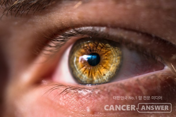 눈에도 암이 발생할 수 있다는 사실을 많은 이들이 잘 모른다./unsplash