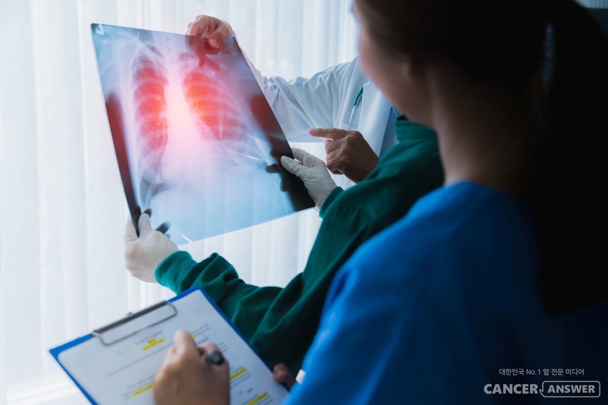 폐암의 상태에 따라 방사선 치료를 할 때, 정밀한 검사를 진행하면 방사선 피해를 최소화하면서 암세포를 사멸시킬 수 있다. / 게티이미지뱅크