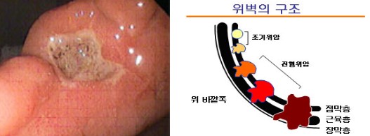 위각부에 생긴 진행성 위암의 사진과 위벽의 구조도. / 세브란스암병원 홈페이지