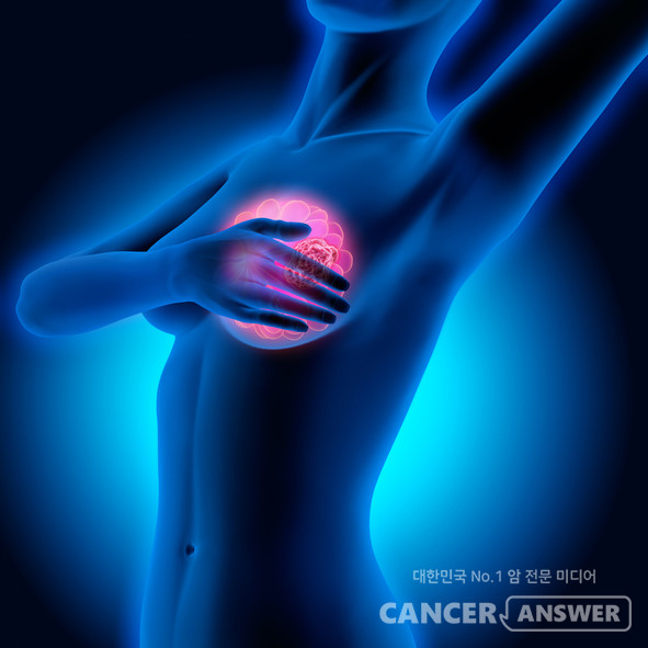 똑부러지는 유방암 원인은 아직 모르지만 유방암 발병 위험을 높이는 위험 인자로 꼽히는 요소들은 있다. 위험인자에 노출된 사람들은 유방암 검진을 정기적으로 받아야 한다../게티이미지뱅크