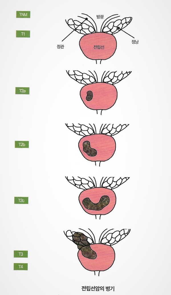 자료 전립선암완치설명서(세브란스병원 전립선암팀 지음, 헬스조선 발행).