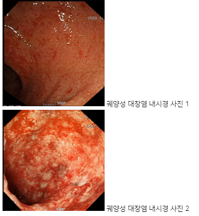 궤양성 대장염 환자의 내시경 사진. /대한소화기학회 캡처