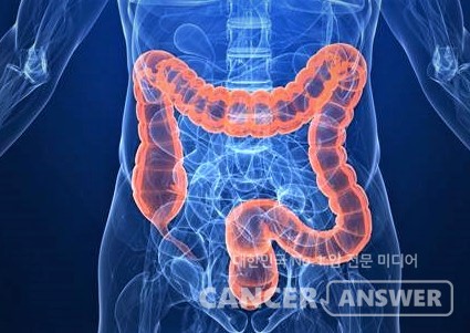 우리나라 대장암 발병률은 전 세계에서 2위로 높지만 발생 대비 사망률은 매우 낮다. /게티이미지 뱅크