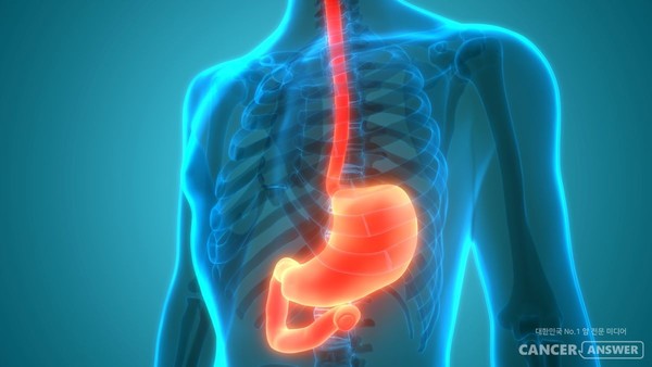 복강경 수술이 진행성 위암에서도 효과적이라는 연구 결과가 발표됐다. /게티이미지 뱅크