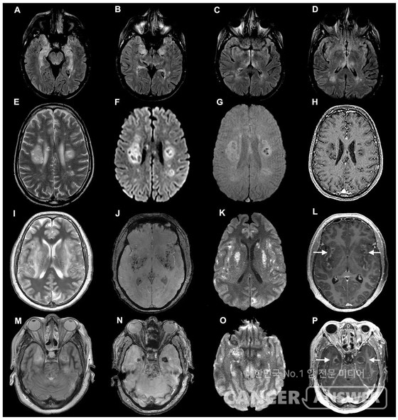 코로나 바이러스 환자의 뇌 스캔./뉴욕타임스 캡처