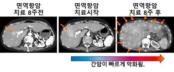 면역항암 치료를 받은 일부 간암환자에게서 나타나는 급성진행 현상을 관찰한 CT 영상 이미지. 밝게 보이는 부분이 간암 병변이다./차의과학대 제공