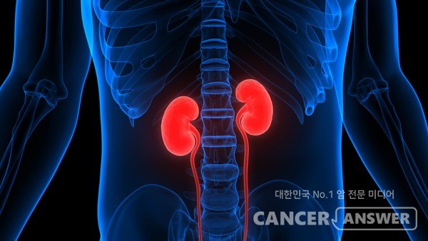 요로결석은 소변이 생성되는 신장, 소변의 배출 통로인 요관과 방광에 생기는 결석(돌)이다./게티이미지뱅크