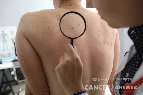 몸에 점이 많으면 피부암이 생길 위험이 높을까? /게티이미지뱅크