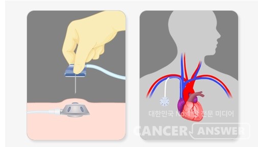몸 내부에 정맥중심관을 삽입하는 케모포트. /사진출처=국립암센터