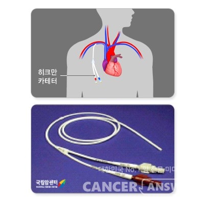 히크만 카테터는 중심 정맥에 삽입된 기구의 줄 부분이 외부로 돌출된 형태다. /사진출처=국립암센터