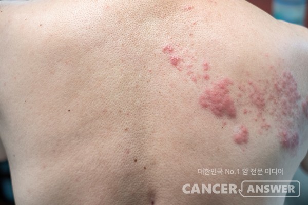 면역력이 떨어지는 환절기에는 대상포진을 조심해야 한다. 면역력이 약한 암환자 등은 각별한 주의가 요구된다. /게티이미지뱅크