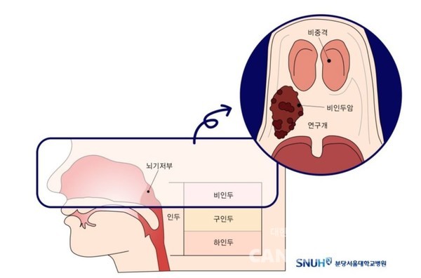 비인두암은 인두의 가장 윗부분인 비인두에 발생하는 악성 종양으로 희귀암 중 하나이다. /사진출처=분당서울대병원 홈페이지
