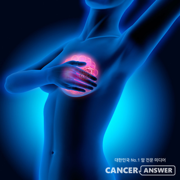 여성 암은 전체적으로 감소 추세인데, 유독 유방암 환자는 늘고 있다는 생명보험협회 자료가 나왔다./게티이미지뱅크