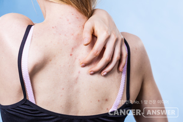 겨울철 각질이 쌓여 피지 배출이 원활하지 않으면 등드름이나 가드름이 발생하기 쉽다. /게티이미지뱅크