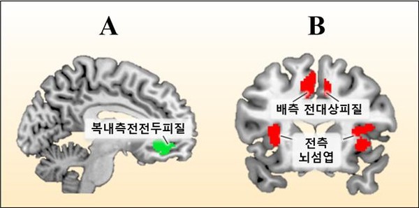 A. 신체질환자, B. 정신질환자에게 위로와 격려를 보냈을 때, 이를 바라보는 정상인의 뇌를 기능적 자기공명영상(fMRI)으로 촬영했다. 각각 활성화 부위가 다른 것을 볼 수 있다. /사진제공=서울대병원