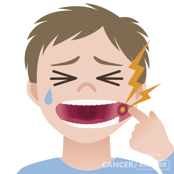 입안에 생긴 궤양이 잘 낫지 않고 2주 이상 지속된다면 구강암을 의심해봐야 한다. /게티이미지뱅크.