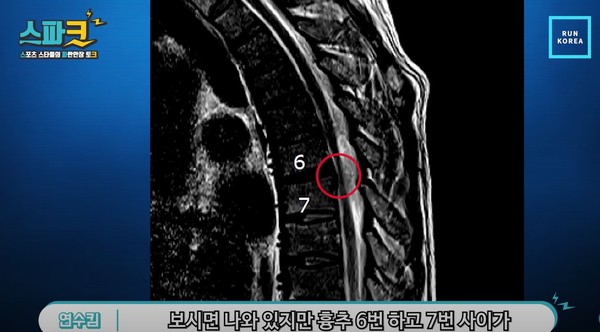 이봉주는 "100프로 확실하지는 않지만 흉추 6.7번 사이의 낭종에 신경을 누르는 게 원인인 것 같다"고 말했다./유튜브 'RUNKOREA-런코리아' 캡처