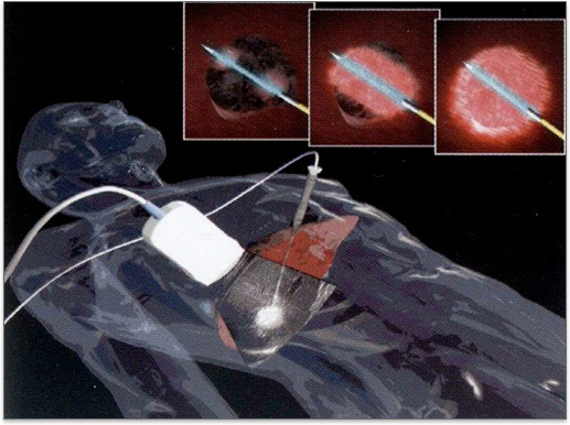 고주파열치료술 /출처-삼성서울병원 홈페이지