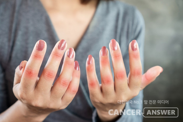 자고 일어났을 때 관절이 아프고 뻣뻣해지는 조조강직이 1시간 이상 지속되면 류마티스 관절염을 의심해봐야 한다./게티이미지뱅크 