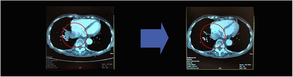 김숙자씨가 제공한 지난 4월의 오른쪽 폐 CT 검사 사진(오른쪽). 이전까지 5cm였던 암세포(왼쪽 붉은색 원안)가 확연히 줄었다.