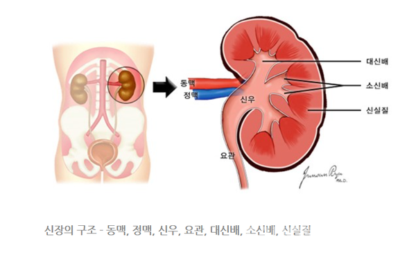 신장의 악성 종양은 발생하는 위치에 따라 신실질의 종양과 신우의 종양으로 나뉜다./출처 국가암정보센터