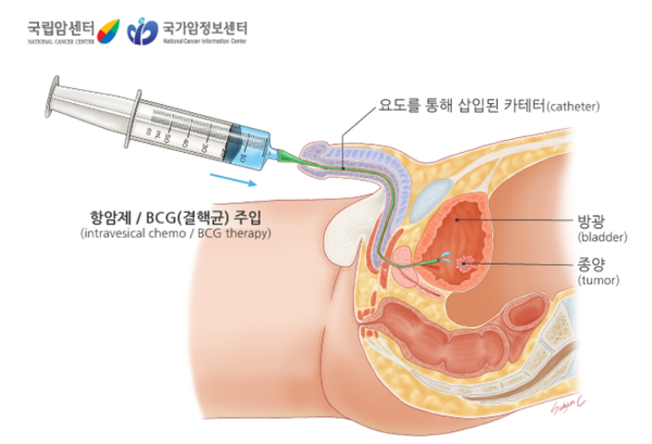 방광 내 BCG 주입요법은 주 1회씩 6주에 걸쳐 방광에 BCG 균을 주입한다./국가암정보센터