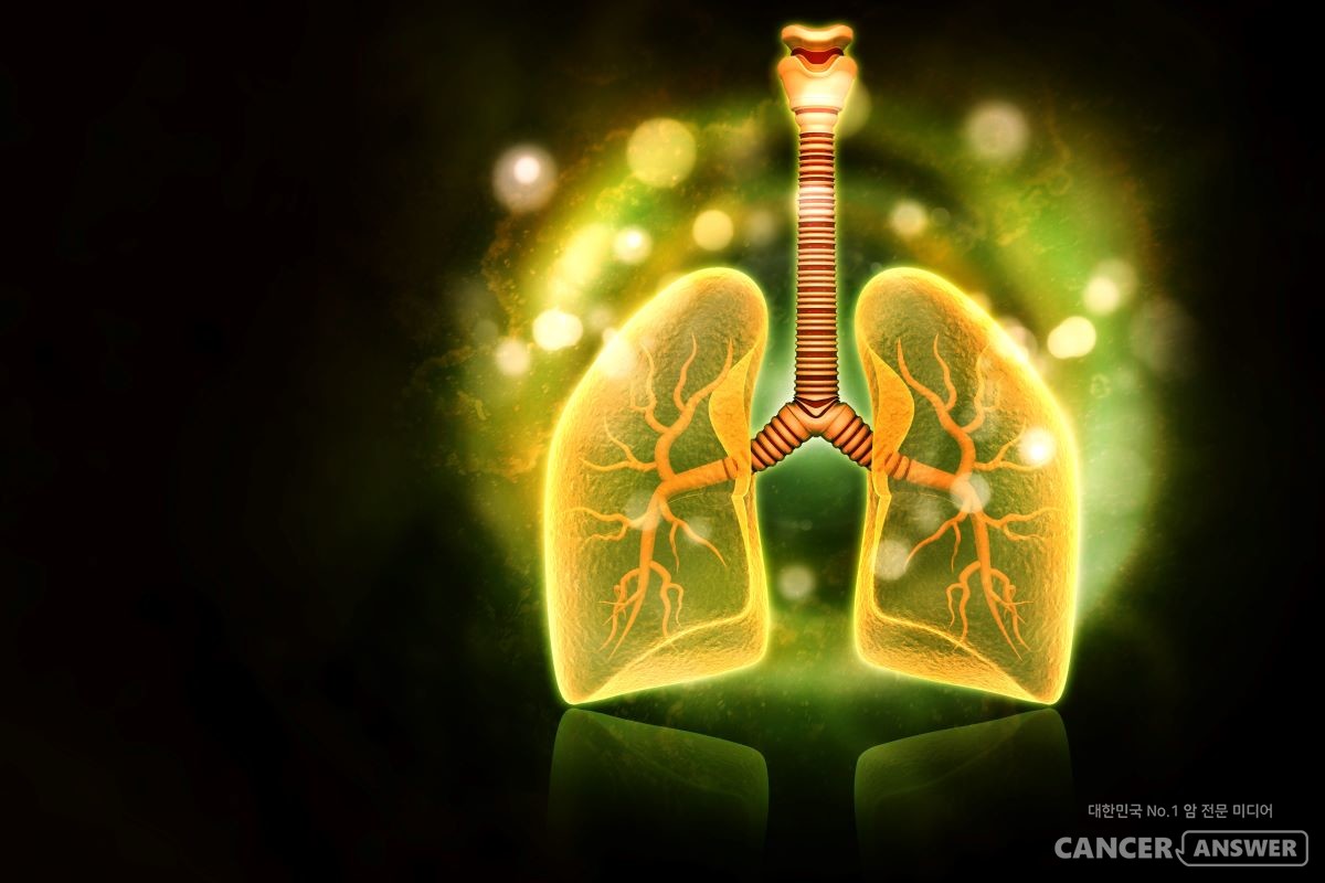 비소세포폐암 면역항암제 치료의 반응을 잘 예측할 수 있는 알고리즘을 연세암병원 연구팀이 개발했다. / 게티이미지뱅크