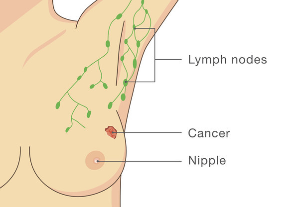유방암에서 감시림프절은 중요하다. 광범위한 겨드랑이 절제술을 피할 수 있기 때문이다./게티이미지뱅크