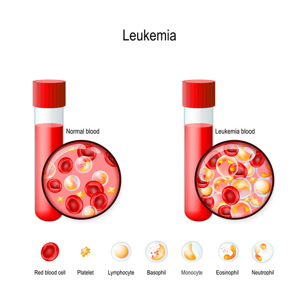 정상 혈액(왼쪽)과 백혈병 상태의 혈액(오른쪽)./게티이미지뱅크