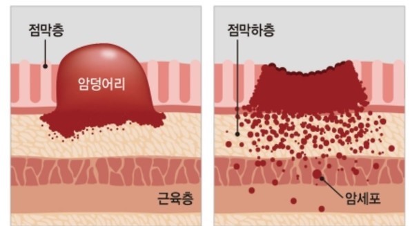왼쪽이 일반적인 '장형 위암'이고 오른쪽이 젊은층에 많이 생기는 '미만형 위암'이다.