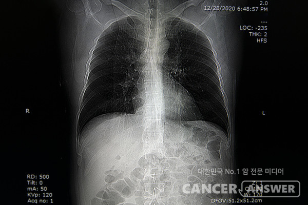 간유리 결절은 폐 꽈리 부근에 뿌옇게 음영이 보이는 상태를 말한다. /게티이미지뱅크