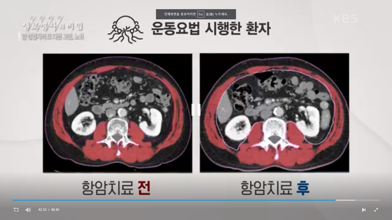 KBS1 '생로병사의 비밀- 암 경험자의 또 다른 고민, 노화'의 한 장면.