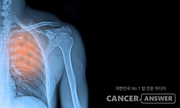 12일은 '세계 폐렴의 날'. 국내에서도 여전히 심각한 사망원인의 하나인 폐렴에 대한 인식 전환이 필요하다. / 게티이미지뱅크