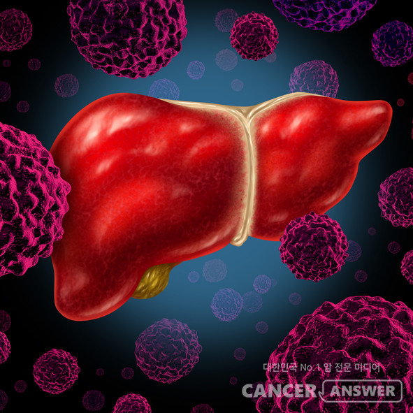 간암이 폐로 전이돼 수술을 받을 수 없었던 환자가 세브란스병원 장기이식센터에서 간이식 수술을 받은 뒤 8년째 암 재발이 없는 것으로 확인됐다. / 게티이미지뱅크