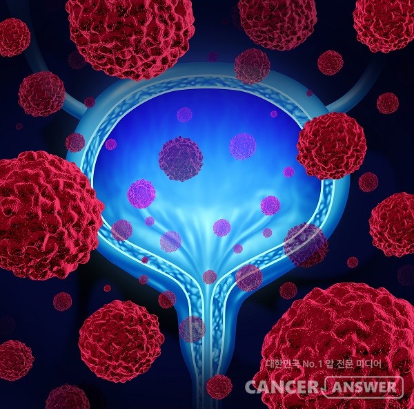 요도암, 방광암, 신우요관암의 이행세포암은 '요로상피세포암'이라 부르기도 한다./게티이미지뱅크