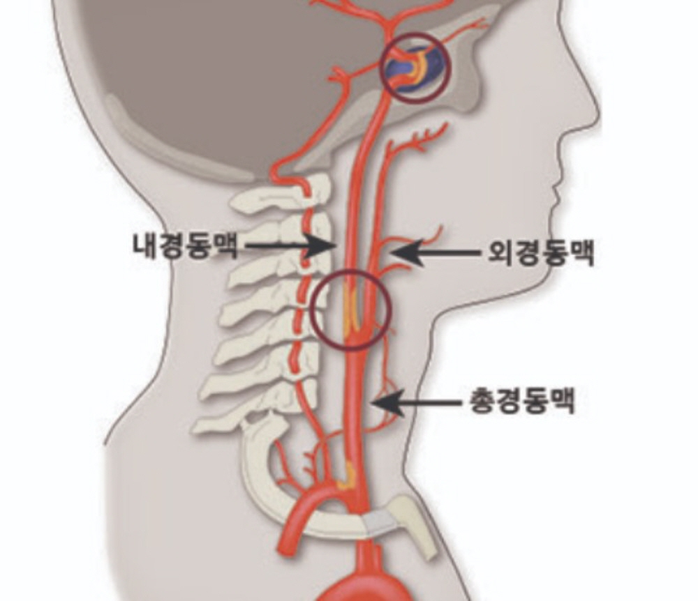 증상이 없어 방치되기 쉬운 치명적인 질병 경동맥 질환 환자가 2020년 10만명에 달했다는 건보공단의 발표가 나왔다. / 자료 서울삼성병원
