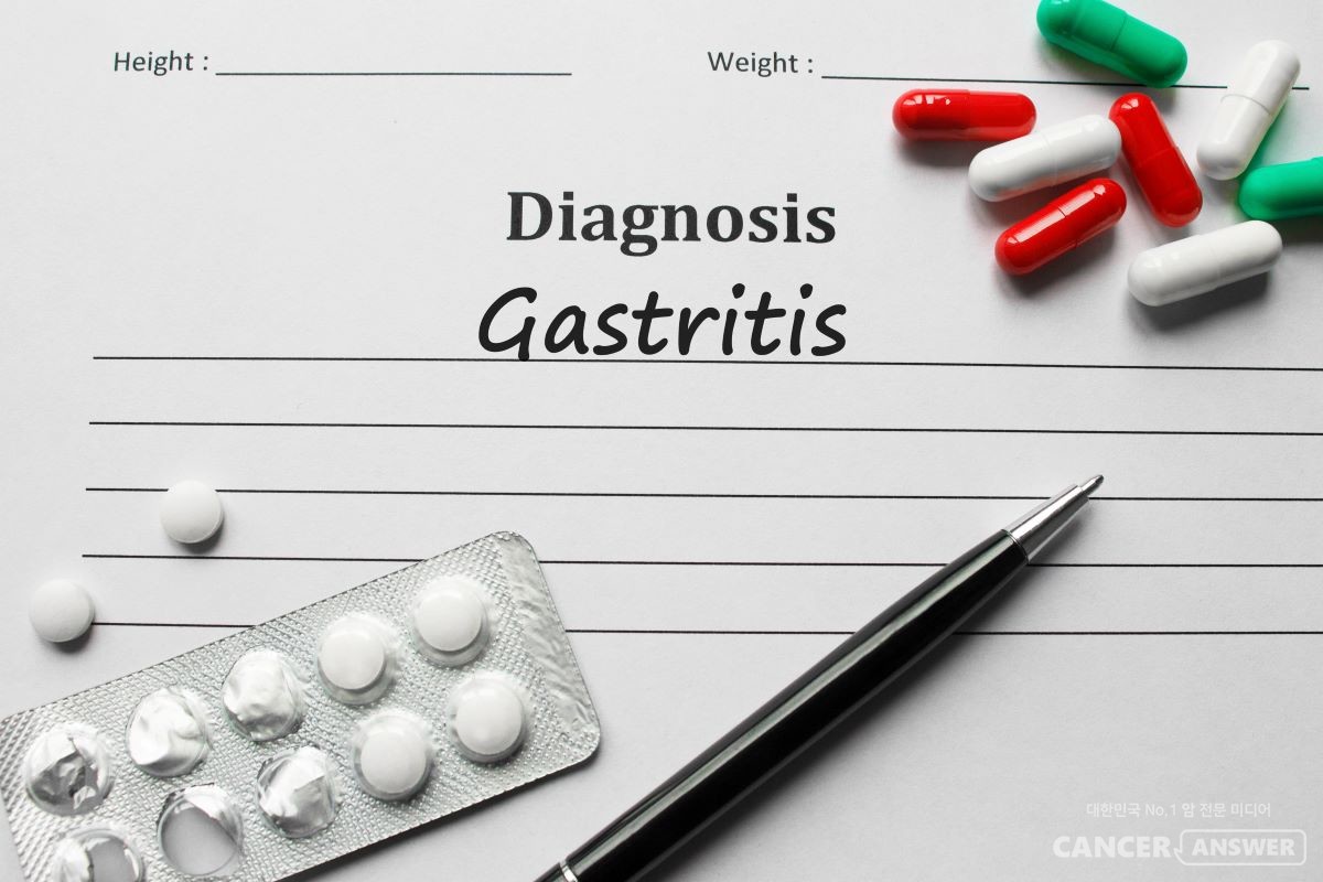위염 치료제를 한달 이상 장기 복용하면 위암 발생 가능성이 급격히 증가한다는 연구결과가 나왔다./ 게티이미지뱅크