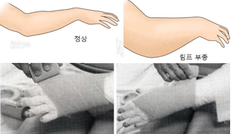 림프부종의 증상과 림프부종을 치료하기 위한 붕대요법. / 서울아산병원, 서울대병원