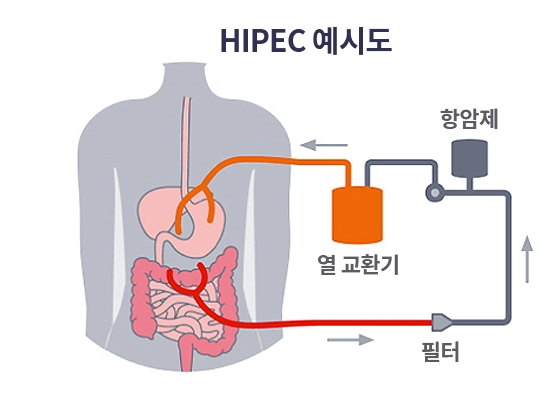 하이펙 개념도. /분당차병원 하이펙센터 자료