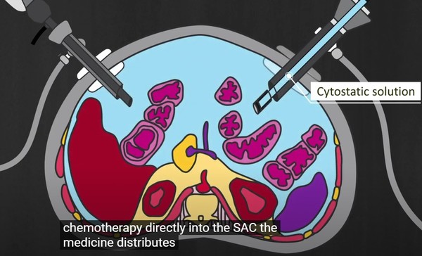 복강에 공기를 주입한 뒤 항암제를 투여하는 파이팩 개념도./The Hospital Research Foundation Group 유튜브 캡처.