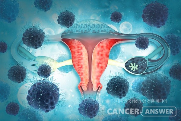 자궁경부암 세포의 항암제 내성과 관련된 단백질이 발견돼 눈길을 끈다./게티이미지뱅크