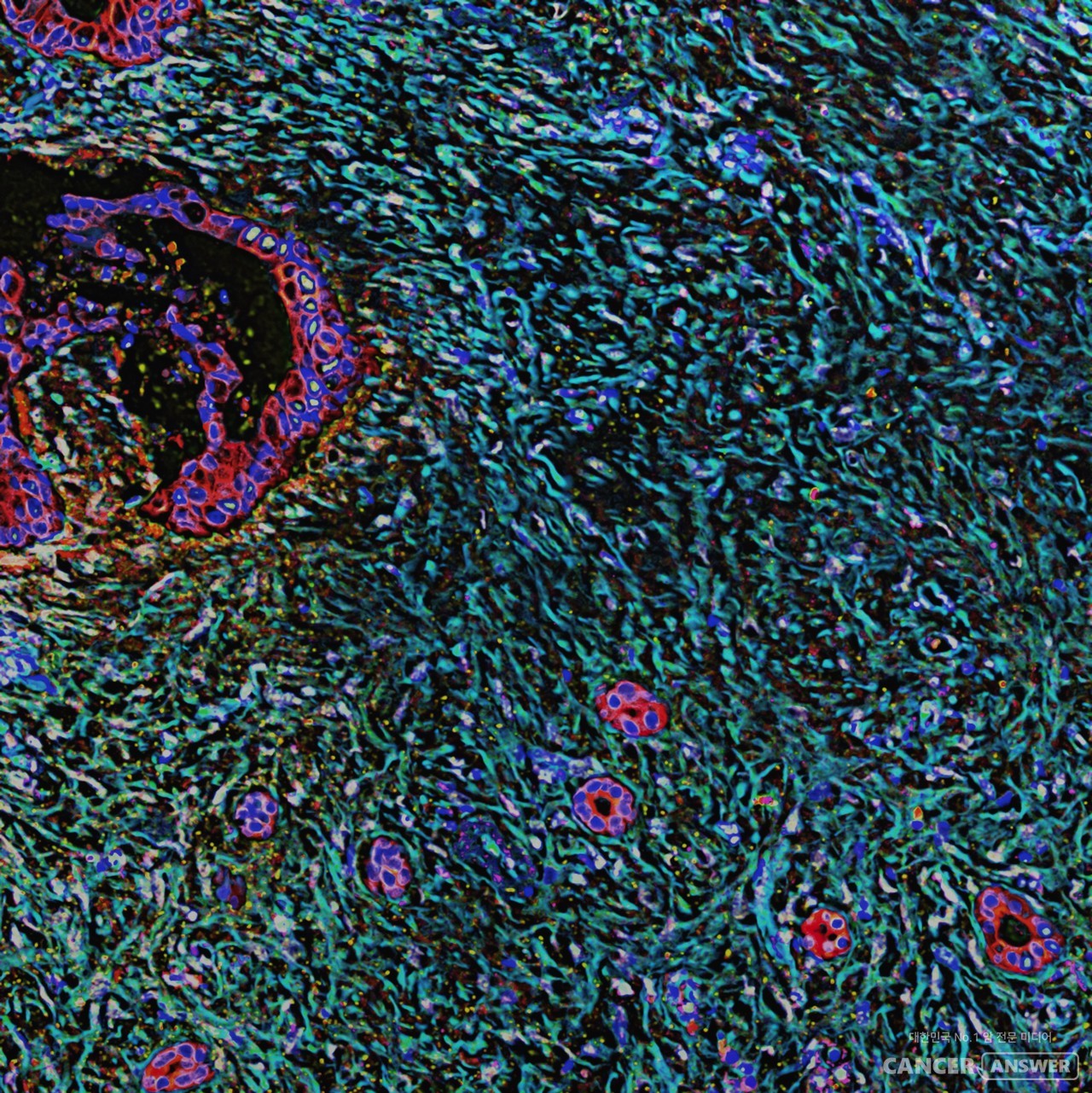 췌장에 나타난 암세포. / unsplash