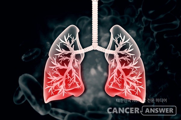 폐 간유리결절의 음영이 증가하면 폐암으로 진행되고 있을 가능성이 있다./게티이미지뱅크
