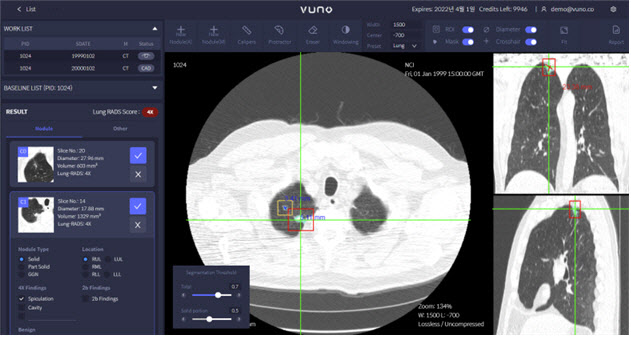 인공지능(AI) 판독보조시스템을 이용한 흉부CT 판독 영상(㈜VUNO MED_LungCT AI).