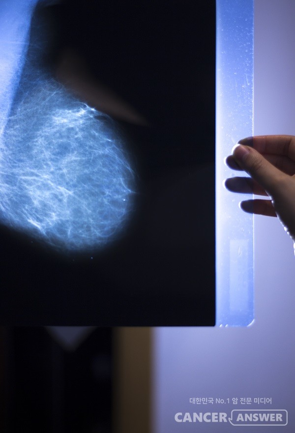 유방암은 침윤 정도에 따라 두 가지로 나뉜다./게티이미지뱅크