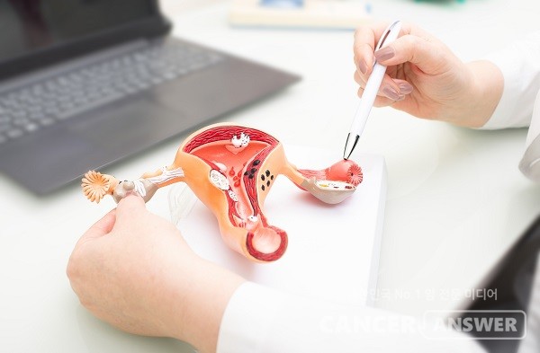 여성들은 난소암 외에 난소 경계성종양도 조심해야 한다./게티이미지뱅크