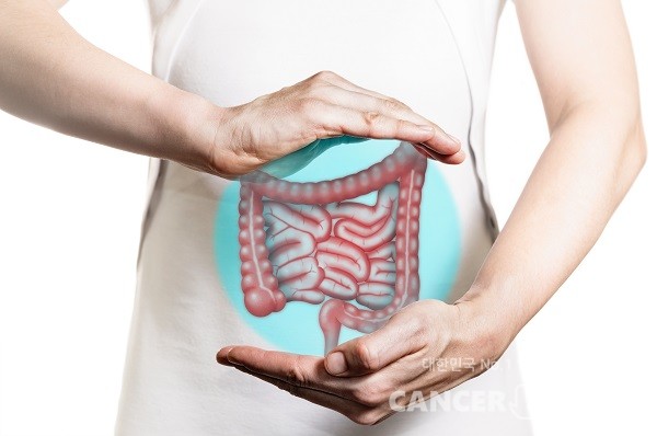 장루조성술은 직장암 환자에게 많이 시행된다./게티이미지뱅크